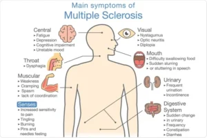 symptom of sclerosis