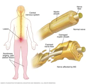 multiple sclerosis