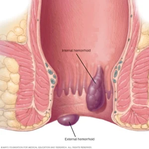 what are hemorrhoids?