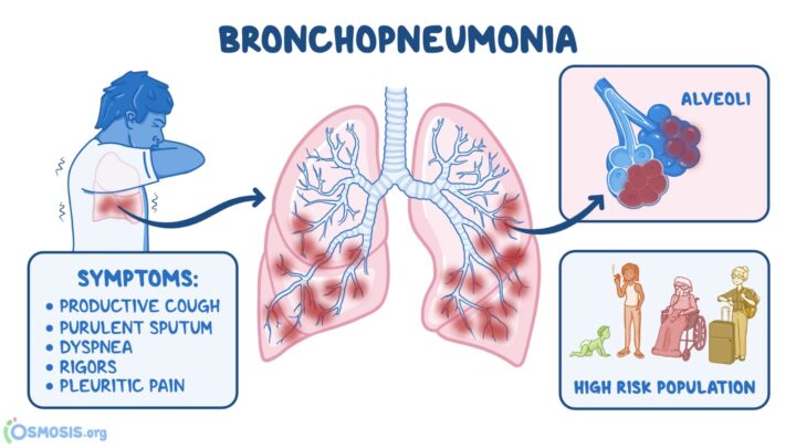 Why Cough With Pus And Chest Pain Occur? 